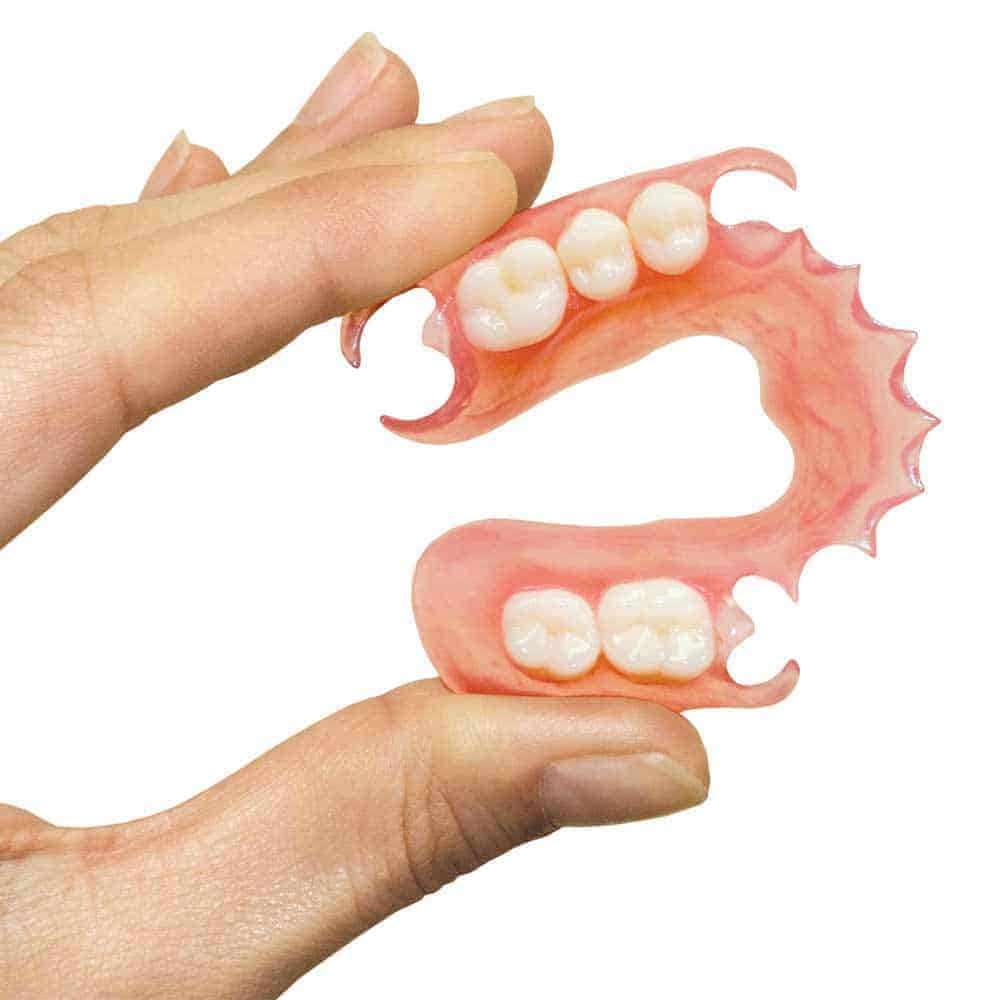 Photo of cast metal partial denture